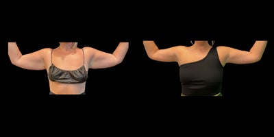 25-34 year old woman treated with Arm Lift - An arm lift, or brachioplasty, is a surgical procedure designed to remove excess skin and fat from the upper arms to create a slimmer, more toned appearance. This procedure is ideal for individuals who experience sagging or loose skin due to aging or significant weight loss. By tightening the underlying tissues and removing unwanted skin, an arm lift enhances arm contours and restores a more youthful, sculpted look. Results are long-lasting, and with proper care, scars typically fade over time.