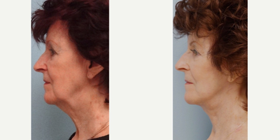 75 and up year old woman treated with Facelift - This pleasant lady undergoes full facelift, necklift, platysmaplasty, and ERB:YAG laser ablation of skin keratoses.  Post-op photos show improved jaw line and reduced neck banding and keratotic spots resulting in a beautiful, natural, rejuvenated result.