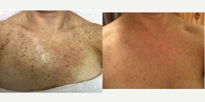 45-54 year old woman treated with Vi Peel - Dream Spa Medical located in Brookline & Canton, MA.