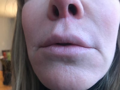 Lip Lift. Washington, DC