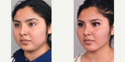 Woman treated with Buccal Fat Removal - Woman treated with Buccal Fat Removal