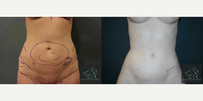 25-34 year old woman treated with Liposuction Revision - Revision liposuction