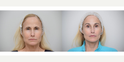 55-64 year old woman treated with Dermal Fillers, RHA Collection Fillers, Dysport - Dysport neuromodulator was used in glabella (frown lines) to reduce tension and 11s. RHA fillers were used around the mouth area to soften smile line (nasolobial and marionettes) and vertical lip lines. Graceful and natural looking skin rejuvenation is essential for well aging.