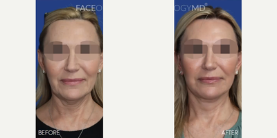Woman treated with Facelift, CO2 Laser - Woman treated with Facelift, CO2 Laser