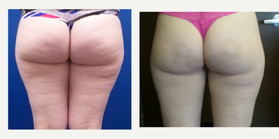 25-34 year old woman treated with Cellfina - 28-year-old lady underwent Cellfina cellulite reduction of the Buttocks & Thighs.