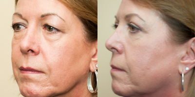 45-54 year old woman treated with Eyelid Surgery - Jane underwent an upper eyelids blepharoplasty. Her upper eyelid surgery helped her to appear more refreshed.
