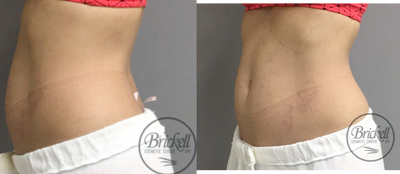 35-44 year old woman treated with UltraShape Power - 6 weeks after 3rd Ultrashape Power treatment.