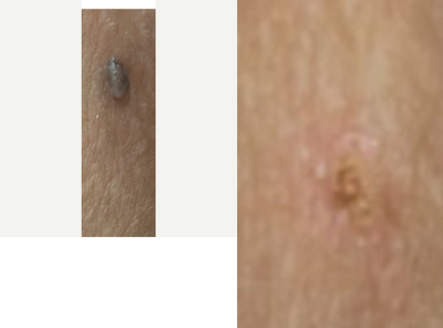 25-34 year old woman treated with UltraPulse CO2 Laser - Skin tag removal