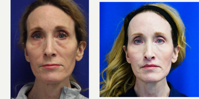 45-54 year old woman treated with Eyelid Surgery, ALMI, Facial Fat Transfer, Lip Lift, Laser Resurfacing, Chemical Peel - Pt under went lower eyelid transconjuctival blepharoplasty, lower eyelid laser resurfacing with fractionated CO2 laser, facial micro and nano fat transfer, deep chemical facial peel, and an upper lip lift under local anesthesia with oral sedation