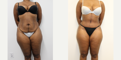 35-44 year old woman treated with Panniculectomy - This female patient had liposuction of her midsection and excision of the excess skin from her abdomen with repositioning of her belly button.