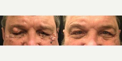 65 year old man treated with Agnes RF for hidrocystomas. - 65 year old man treated with Agnes RF for hidrocystomas.
