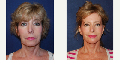 55-64 year old woman treated with MACS Facelift - 60 year old woman, 3 weeks post-op mini lower facelift, necklift, and upper eyelid blepharoplasty.  Scar minimizing technique employed.