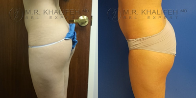 25-34 year old woman treated with Brazilian Butt Lift - A small volume (300 CC) fat transfer and lipo flanks in Asian American patient. The results are the three months postop.