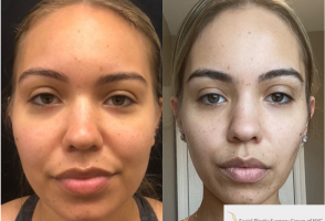 Woman treated with Buccal Fat Removal - Woman treated with Buccal Fat Removal