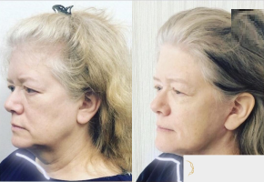 63 year old woman treated with SMAS Facelift - 63 year old woman treated with SMAS Facelift under general anesthesia.