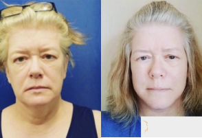 63 year old woman treated with SMAS Facelift - 63 year old woman treated with SMAS Facelift under general anesthesia.