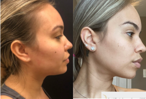 Woman treated with Buccal Fat Removal - Woman treated with Buccal Fat Removal