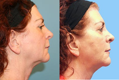 55-64 year old woman treated with Silhouette InstaLift - This patient had 3 Silhouette Instalift sutures in each side of the face (2 in the jaw area on each side and one in the neck on each side).