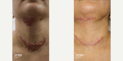35-44 year old woman treated with Laser Scar Removal, Scar Removal, Scar Removal Surgery - Get rid of your burn scars with Onep