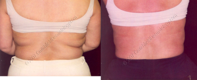 LipoDissolve injections to back fat - 
	LipoDissolve injections to back fat
