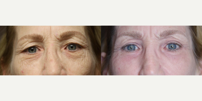 Woman treated with Fractional Laser - Woman treated with Fractional Laser Resurfacing to open up and tighten the upper lids while also eliminating lower eyelid bags