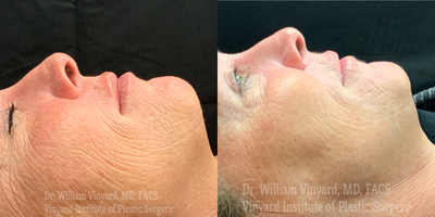 45-54 year old woman treated with CoolPeel - 45-54 year old woman treated with CoolPeel