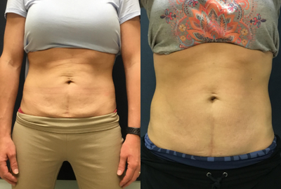 35-44 year old woman treated with TempSure Envi - 3 sessions to abdomen for skin tightening