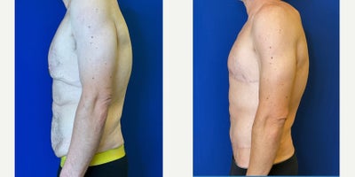 35-44 year old man treated with Gynecomastia Surgery, Nipple Surgery, Tummy Tuck, Liposuction - This patient in his late 30s made a powerful commitment to changeembracing a healthier lifestyle, achieving significant weight loss, and staying dedicated to a consistent exercise regimen.After doing the hard work, he chose to complete his journey with gynecomastia correction using free nipple grafts and a fleur-de-lis abdominoplasty to remove excess skin and restore a stronger, more confident contour.