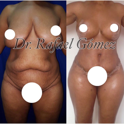 35-44 year old woman treated with Mommy Makeover - Tummy tuck, VASER liposuction, breast lift revision, BBL