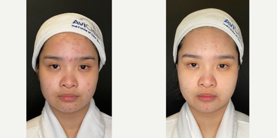 25-34 year old woman treated with AviClear - 25-34 year old woman treated with AviClear