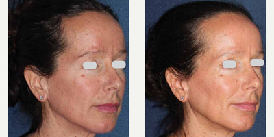 Woman treated with ResurFX - Photo provided courtesy of Lumenis Ltd., performed by Mitchel P. Goldman, MD