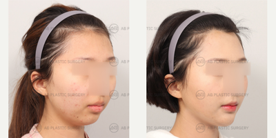 25-34 year old woman treated with Genioplasty, V Line Surgery, Rhinoplasty, Asian Rhinoplasty - V-Line Surgery, GenioplastyRhinoplasty (Nose Ridge+Nose Tip+Hump Correction+Osteotomy)
