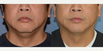 Kybella - Nonsurgical double chin removal with Kybella
