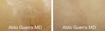 25-34 year old woman treated with Embrace Scar Therapy - Before and after embrace Active Scar Defense treatments for the vertical breast lift incision. Results shown at 1 year 1 month.