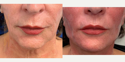 65-74 year old woman treated with  PDO Thread Lift - 65 year old female showing typical signs of aging.  With loss of deeper support tissues which allow the skin and outer fat to fall.  The neck, jawline and cheeks require rejuvenation.Using  a combination of various PDO threads,  Mint and Miracu, the jawline is contoured, jowls are smoothed, the cheek lax skin tightened and the loose neck skin improved.  In addition to these amazing PDO threads, various facial fillers, Radiesse, Restylane and Versa were used to replace lost facial volume.  The Facial Rejuvenation process is an art.. One must be versed in the facial anatomy and have an awareness of the procedures necessary to lift, contour and create a natural appearance.