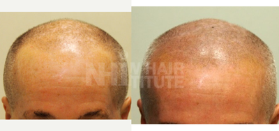 65-74 year old man treated with Scalp Micropigmentation - 65-74 year old man treated with Scalp Micropigmentation