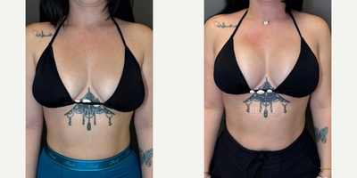 25-34 year old woman treated with Breast Implant Revision, Breast Lift - 30 year old woman treated with Breast Implant Exchange with a Lift