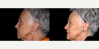72 year old woman treated with 3 syringes of Bellafill to cheeks and under eye - 72 year old woman treated with 3 syringes of Bellafill to cheeks and under eye. Photos depict before and 3 months after treatment.