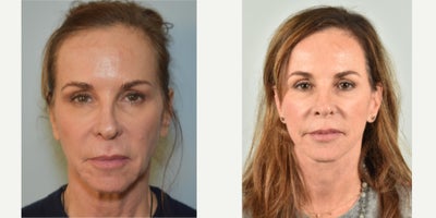 55-64 year old woman treated with Mini Facelift, Neck Lift, Microneedling, Fractional Laser, Facial Fat Transfer - This patient additionally received a lip lift procedure, radiofrequency microneedling, and autologous fat transfer for pre-jowl sulcus. Fractional CO2 was performed to face.