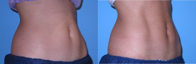 35-44 year old woman treated for CoolSculpting - This 40  y.o. female underwent 2 sessions of coolsculpting&nbsp;