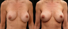 Breast Revision Augmentation   - 
	Right Breast Revision 400/375 cc-Saline
