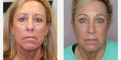 Woman treated with Eyelid Surgery, Brow Lift, Opus Plasma - The patient had a Bilateral Upper and Lower Lid Blepharoplasty combined with a Brow Lift and the Opus Plasma Laser for the neck.