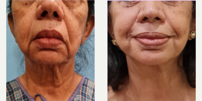 65-74 year old woman treated with Facelift Revision - 72 year old who had a revision face and neck lift.