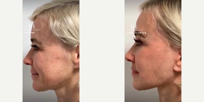 Woman treated with Lip Lift - Woman treated with endoscopic Brow Lift, Eyelid Surgery through upper blepharoplasty, Deep Plane Facelift, Neck Lift, and a subnasal Lip Lift. Patient is shown before and 4 weeks post-op.
