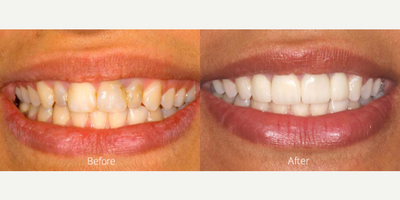 Full porcelain crowns - Tooth whitening was done to brighten up the smile - Upper four front teeth were treated and covered with full porcelain crowns. Tooth whitening was done to brighten up the smile.
