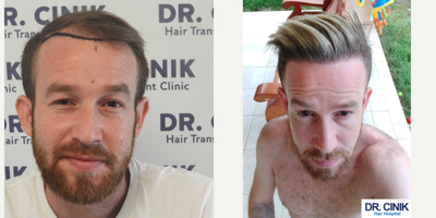 25-34 year old man treated with FUE Hair Transplant - He is made two hair transplant operations.First operation date: 08/06/20184100 total grafts900 body hair193 unique grafts1868 double grafts755 triple grafts384 multiple graftsThe second operation date: 08.05.20195150 total grafts1150 body hair308 unique grafts1617 double grafts1003 triple grafts1072 multiple grafts