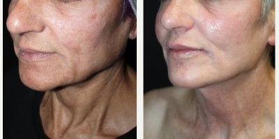 55-64 year old woman treated with UltraClear Laser - Female completed several sessions of the UltraClear.