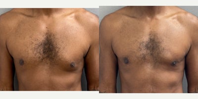 46 yo s/p gynecomastia liposuction and excision performed under local anesthesia with sedation in our on site AAAA certified ope - 46 yo s/p gynecomastia liposuction and excision performed under local anesthesia with sedation in our on site AAAA certified operating suite.