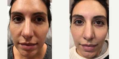 25-34 year old woman treated with Vampire Facelift - Vampire Facelift