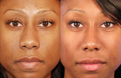 Rhinoplasty - 
	African American rhinoplasty to reshape and define the nasal tip region. Notice maintenance of an ethnically consistent nasal appearance.
